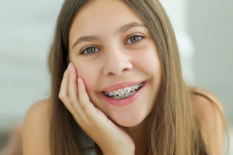 Top Benefits Of Braces