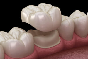 Professional Dental Crowns in Houston, Texas