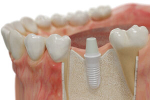 Best Ceramic Dental Implants in Houston, Texas