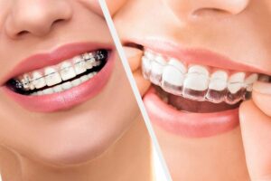Professional Clear Braces in Houston, Texas
