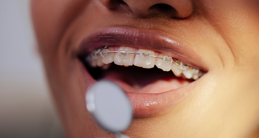 Two-Phase Treatment in Orthodontics in Houston, Texas