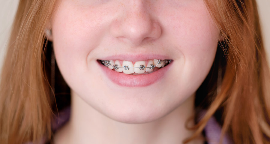 Affordable Braces in Houston, Texas