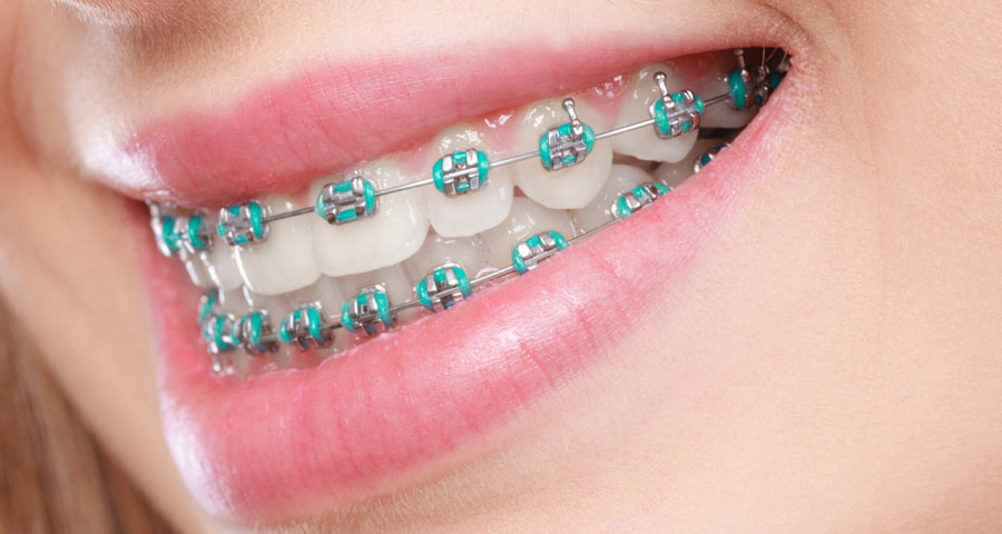 Best Rubber Bands for Braces in Houston, Texas