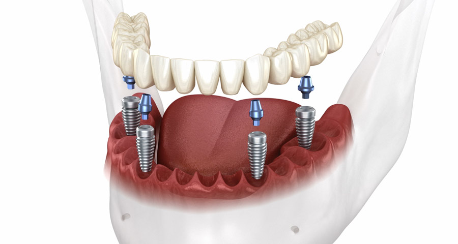 Best Full Mouth Dental Implants in Houston, Texas