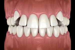 Crowded Teeth Treatment in Houston, Texas