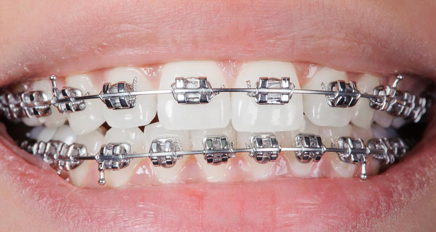 Best Metal Braces in Houston, Texas