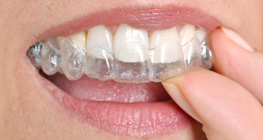 Professional Invisible Aligners in Houston, Texas