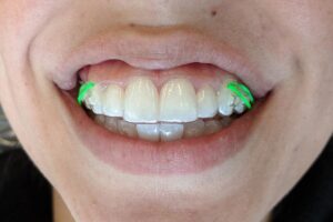 Professional Invisalign Rubber Bands in Houston, Texas