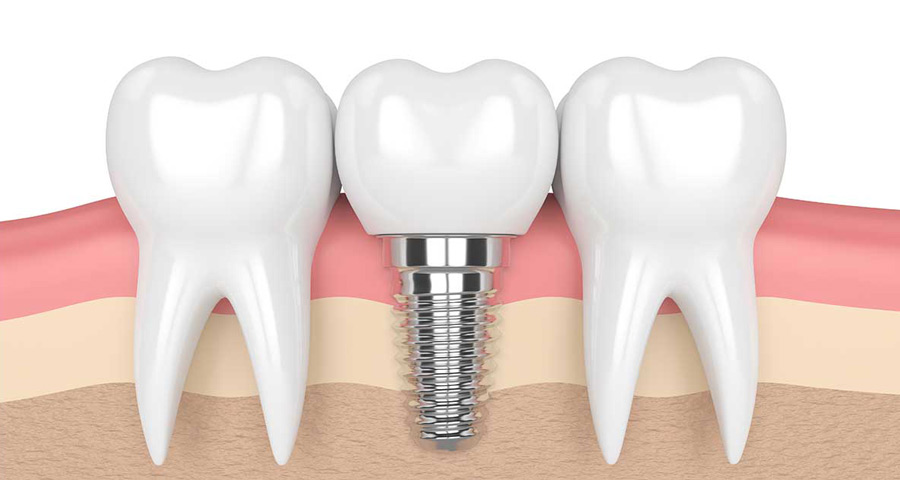 Best Dental Implants in Houston, Texas