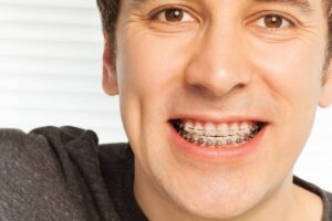 Affordable Braces Cost in Houston, Texas