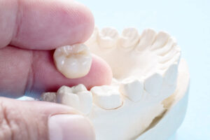 Professional Dental Crowns in Houston, Texas