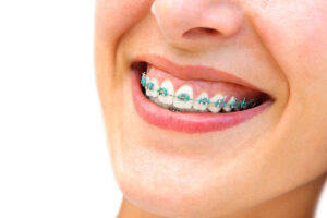 Good Quality Color Braces in Houston, Texas