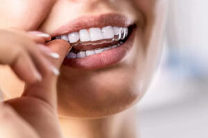 Affordable Invisalign Cost in Houston, Texas
