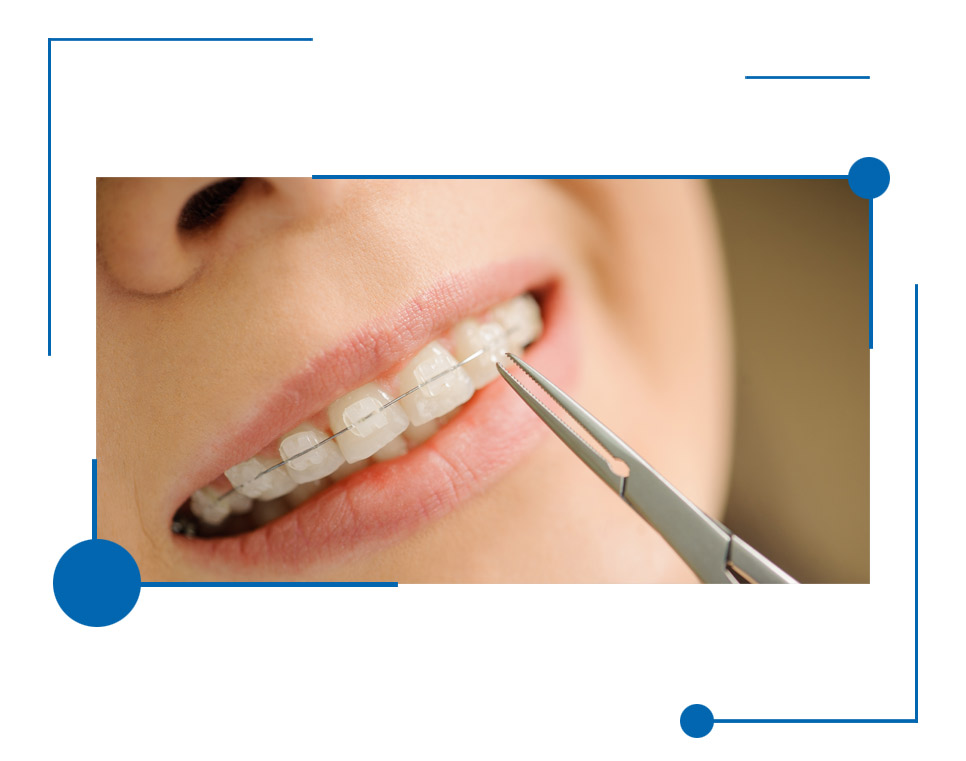 Perfect Dental Braces for Adults in Houston, Texas