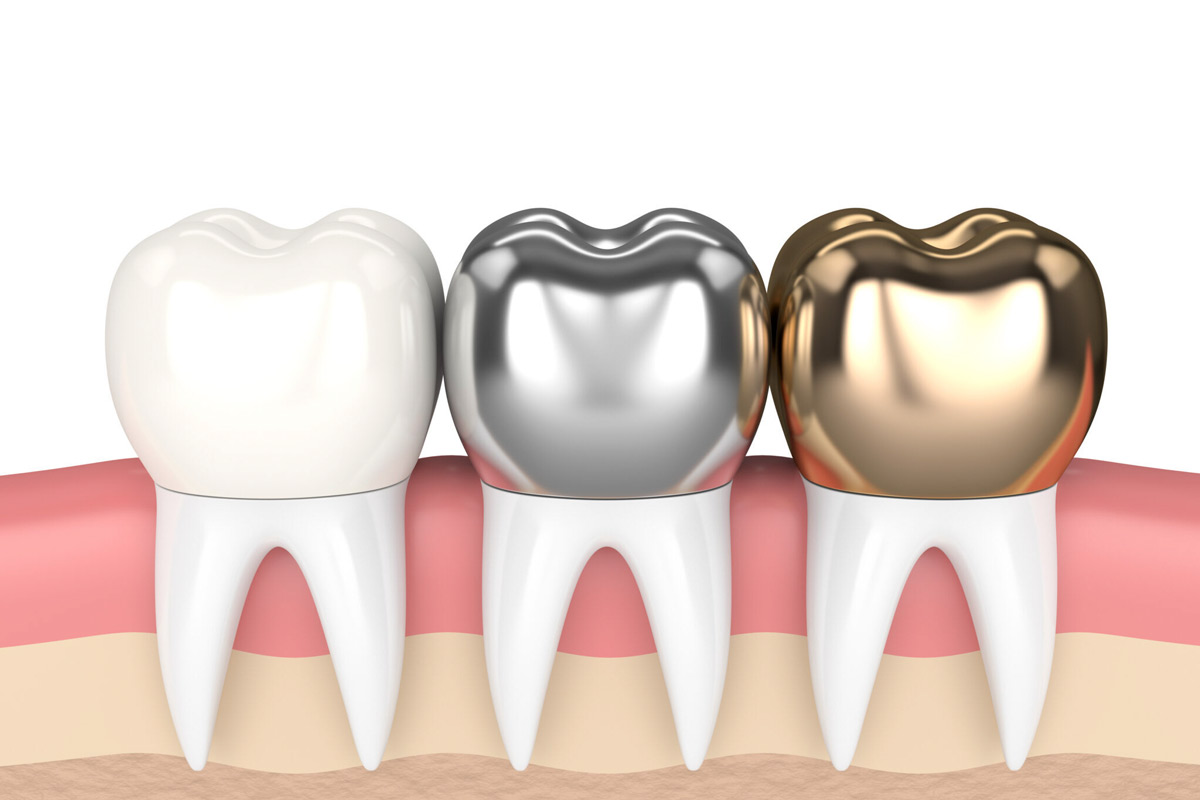 The Best Dental Crowns in Houston, Texas