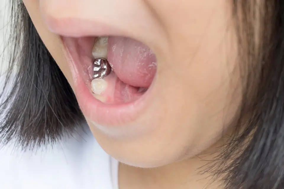 A Guide on How to Take Care of Stainless Steel Crowns