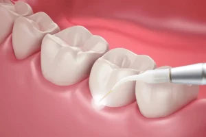How Is Laser Therapy Used to Treat Periodontal Diseases?