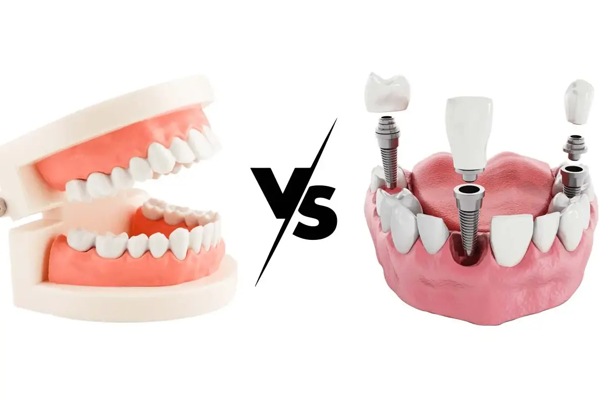 Dentures vs. Dental Implants: Which Option Is Right for Me?