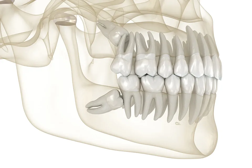 Unraveling the Mystery of Wisdom Teeth: Eruption and Removal