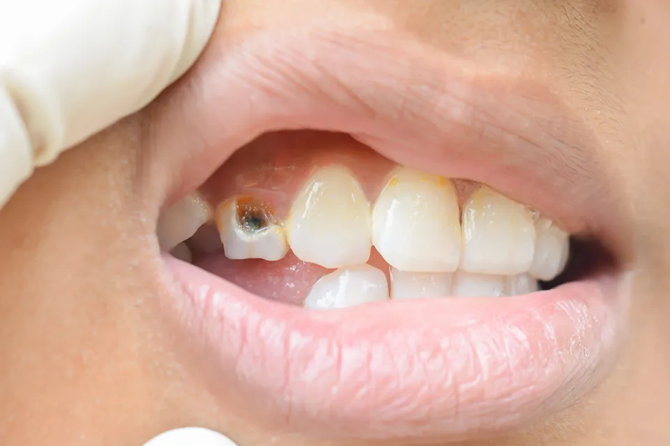 Tooth Broken Below the Gum Line: A Comprehensive Guide