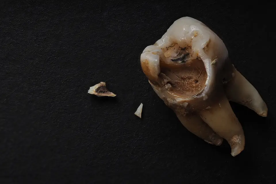 Dead Tooth: The Truth About Causes, Symptoms, and Treatment You Need to Know