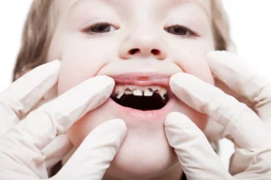 Understanding and Preventing Rotten Teeth