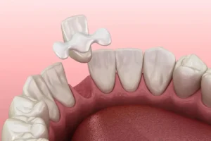 The Benefits of a Front Teeth Bridge