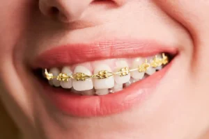 Embracing Gold Braces at Zara Dental in Houston, Texas