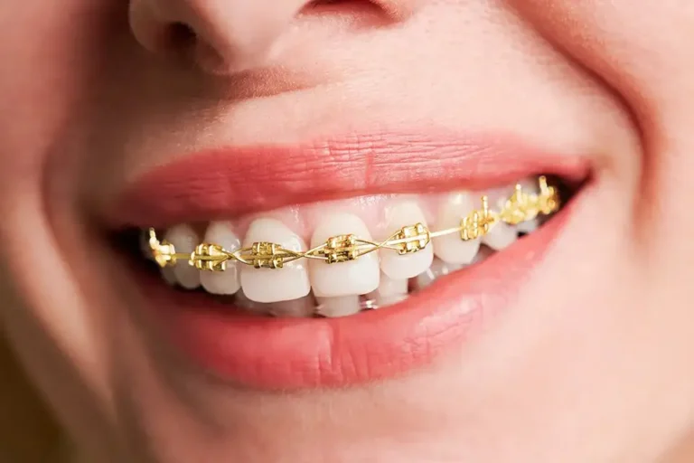 Open Bite - Zara Dental Clinic - Houston - (713) 766 1122