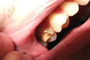 What to Do If Your Molar Tooth Breaks?