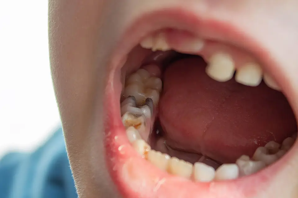 Rotten Teeth: The Truth About Symptoms and Treatment