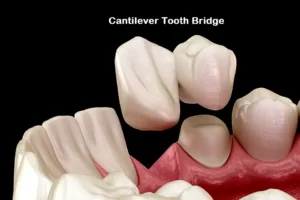 Cantilever Dental Bridges