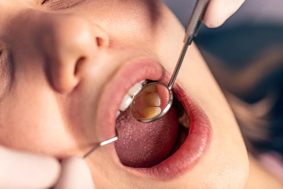 Oral Cyst Removal in Houston: Your Guide to Expert Care