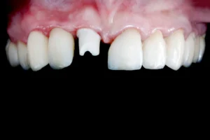 Front Tooth Crowns