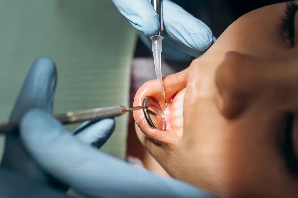 Pericoronitis: A Common Dental Condition Simplified for Better Understanding