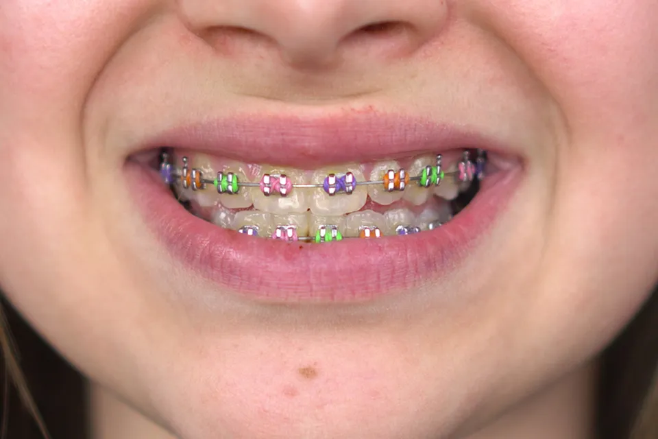 Braces Colors For Girls: Fun Orthodontic Treatment