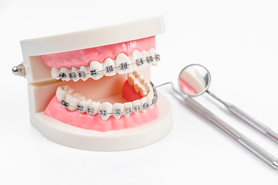 Braces Insurance: Navigating Your Options
