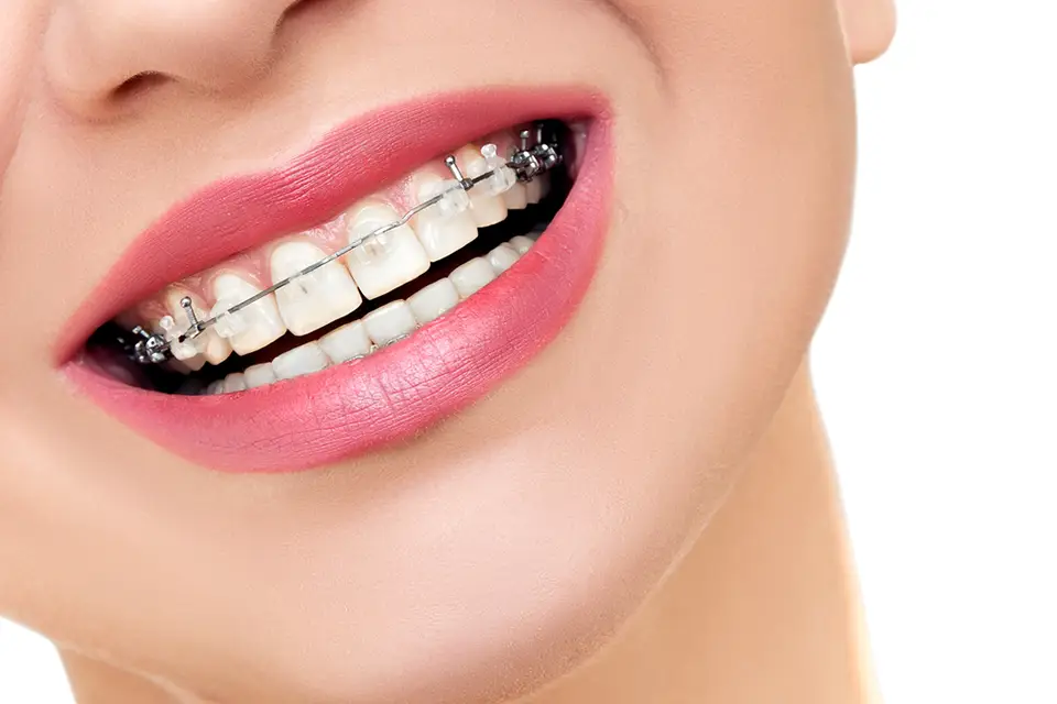Clear Braces for Adults: Discreet Orthodontic Treatment