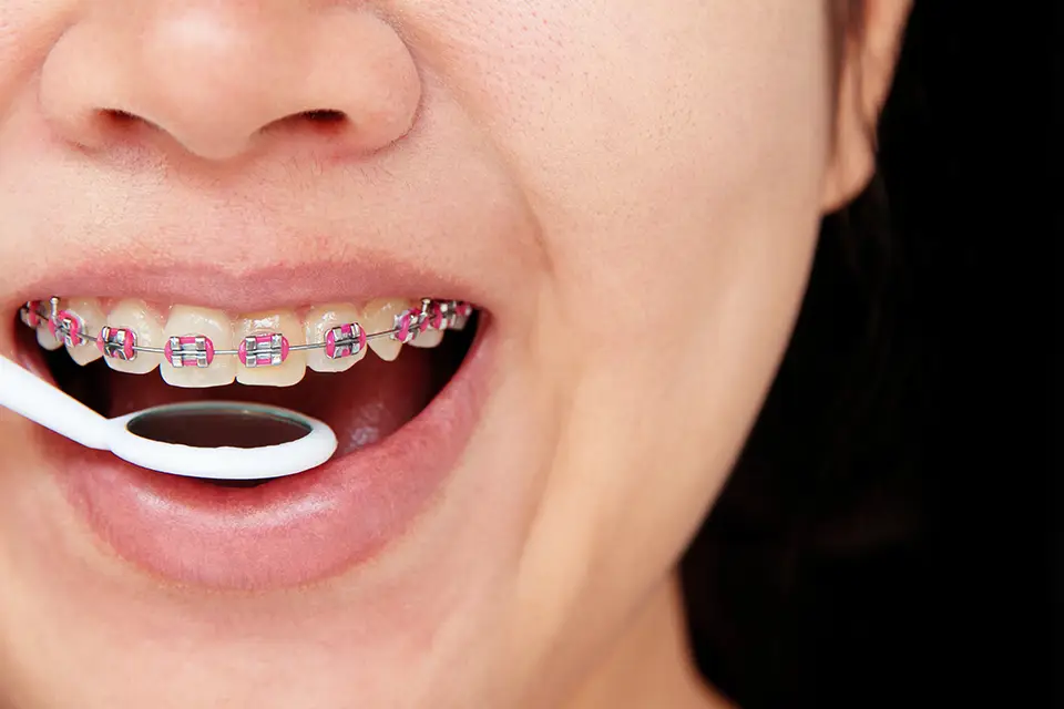 Advantages and Disadvantages of Porcelain Braces: What You Need to Know