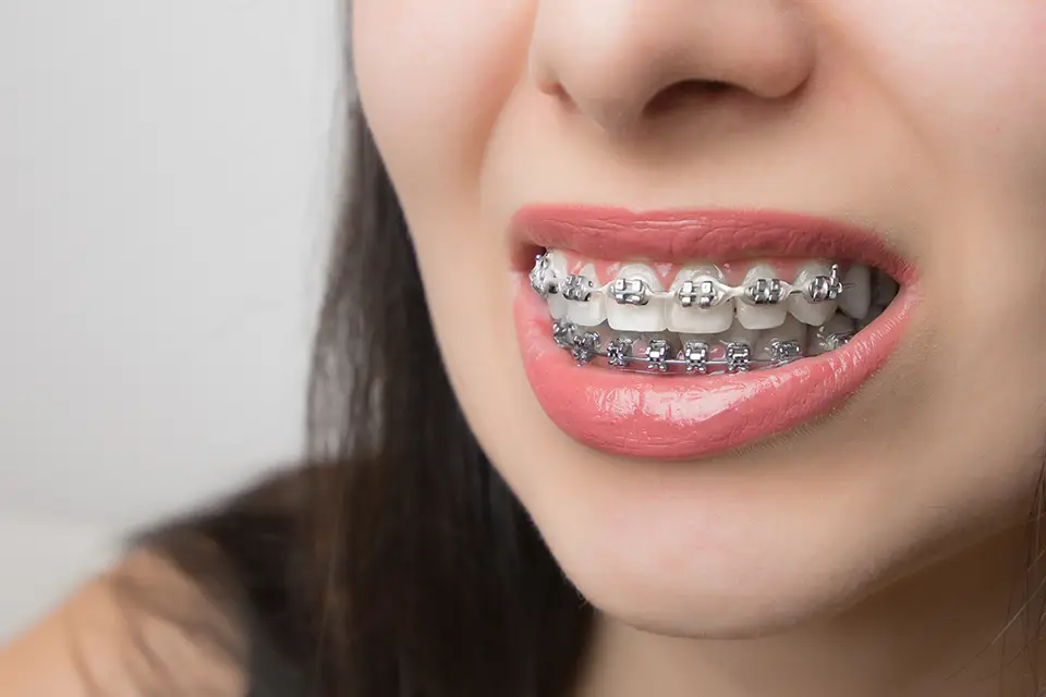 Advantages and Disadvantages of Metal Braces: What You Need to Know