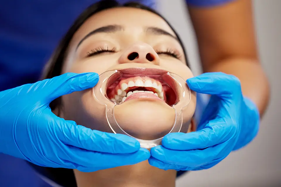 Permanent Retainers: Everything You Need to Know About