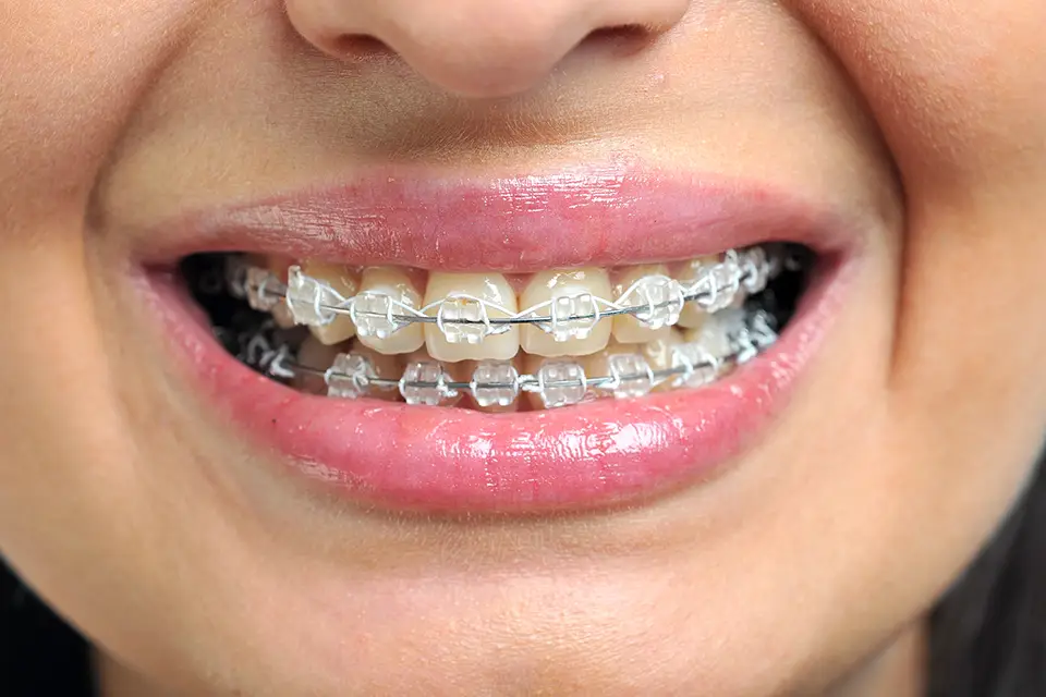 Clear Braces for Adults: The Best Types, Benefits and Cost
