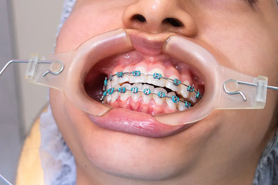 How To Fix A Misaligned or Crooked Jaw?