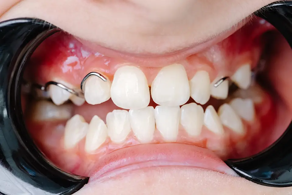 dental braces process - Zara Dental Clinic - Houston Best Retainers in Houston, Texas