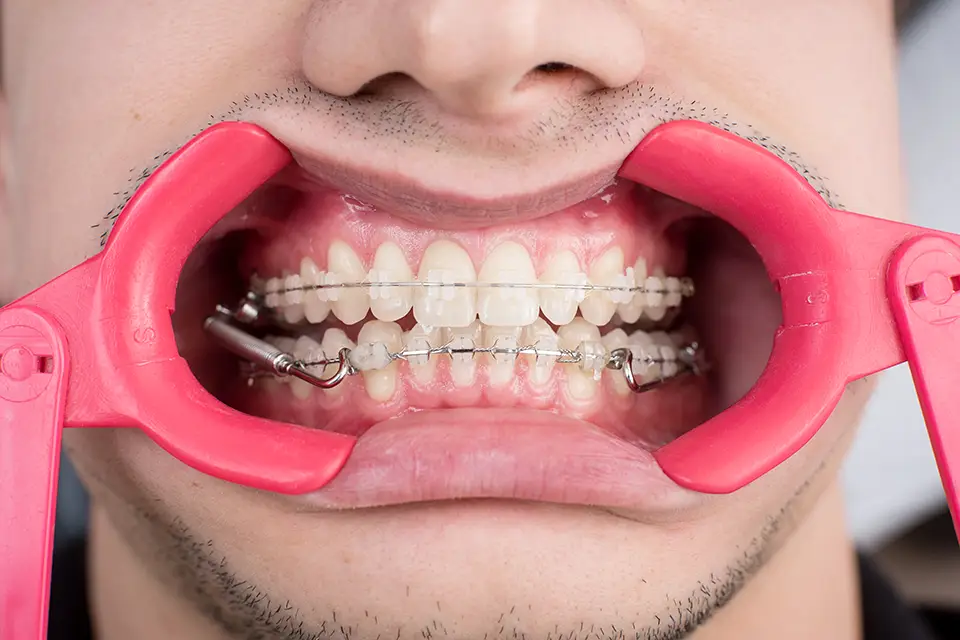 dental braces - Zara Dental Clinic - Houston Professional Misaligned Jaw Treatment in Houston, Texas