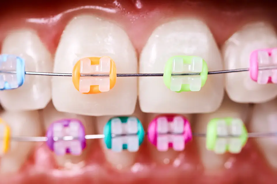 What Do Rubber Bands Do for Braces? Everything You Need to Know