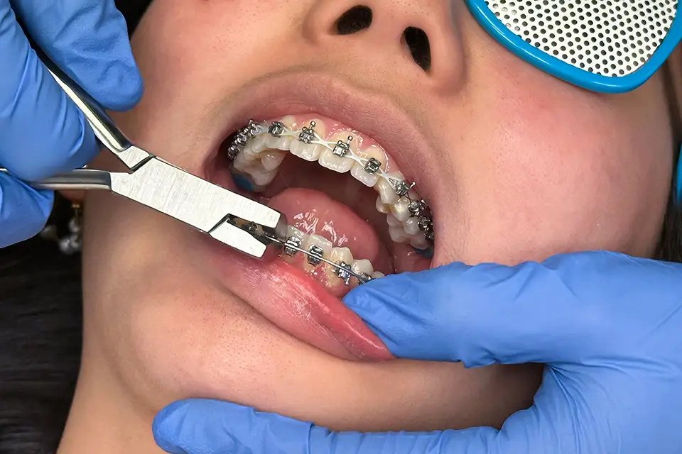 braces installment - Zara Dental Clinic - Houston The best Invisalign Alternatives
