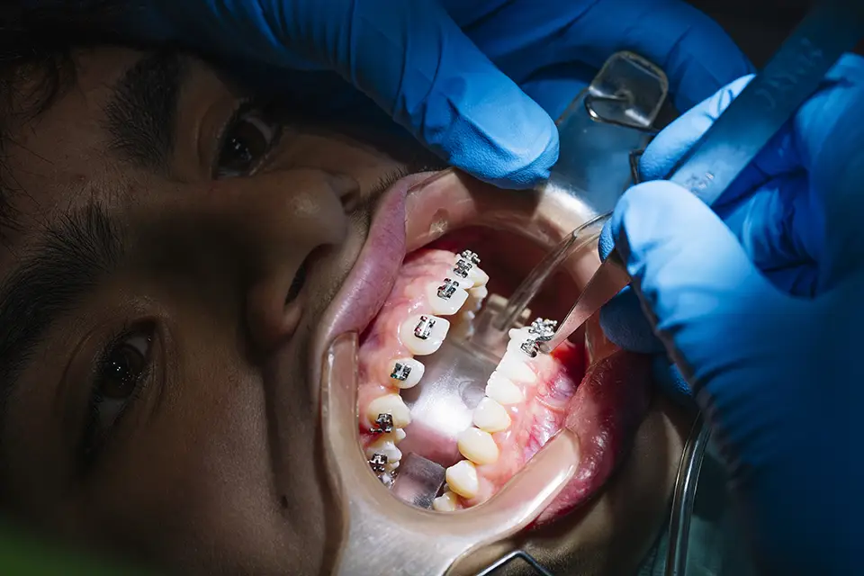Dolor de Invisalign: Entender y Gestionar el Malestar
