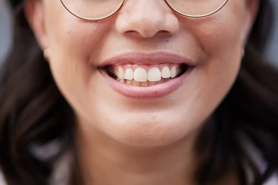 teeth close up - Zara Dental Clinic - Houston How to Get Rid of Crossbite