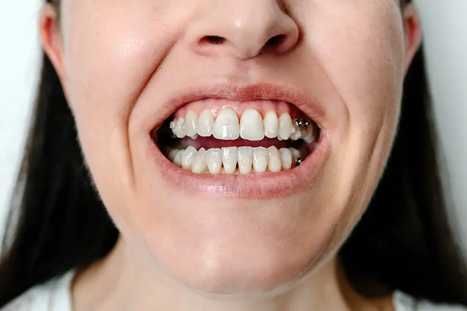 Comprender las Infecciones Dentales: Una Guía de Zara Dental